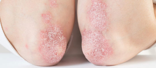 psoriasis des mains