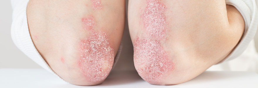 psoriasis des mains